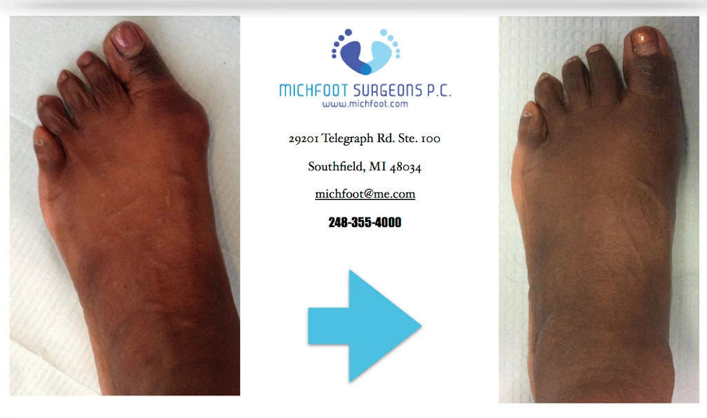 Before and After Image of Bunion Surgery performed by Michigan Foot Surgeons at Michfoot