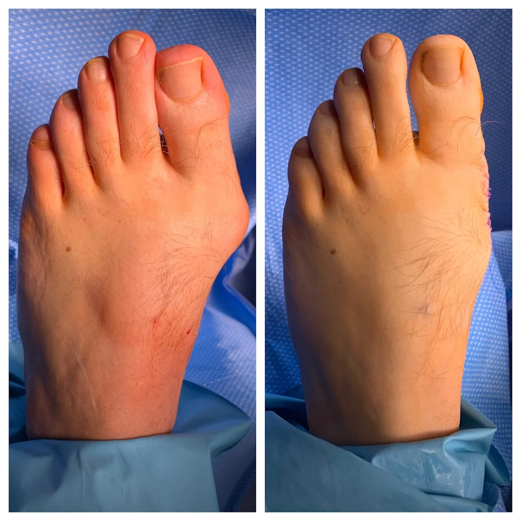 Before and After Image of Bunion Surgery performed by Michigan Foot Surgeons at Michfoot